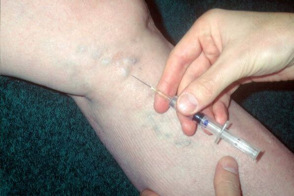 skleroterapia për venat me variçe