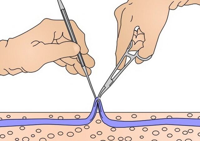zhveshja e venave për venat me variçe